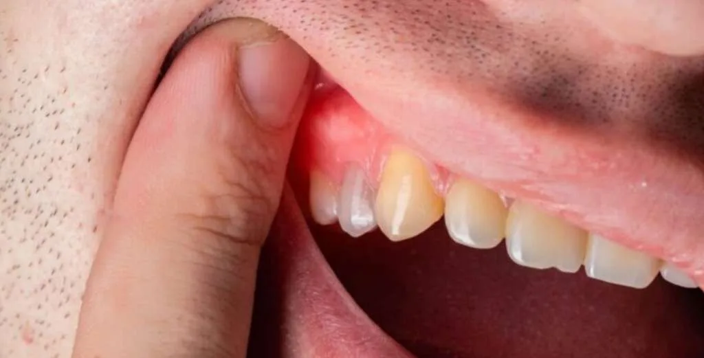 Periodontista Abscesso Dental