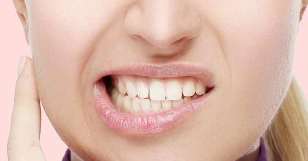 O que é o Bruxismo, tratamentos, ansiedade e cura