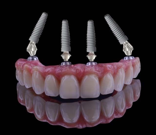 Implante de Todos os Dentes