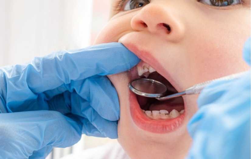 Dentista Infantil Odontopediatra São Paulo remoção de Cáries