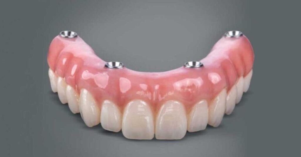 Implante Total de Todos os Dentes