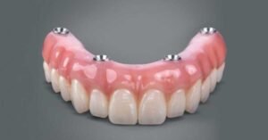 Implante de Todos os Dentes: Como é feito