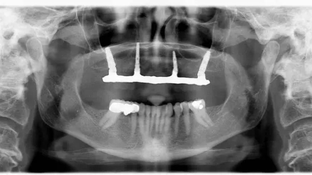 Radiografia panorâmica mostrando implantes All-on-4 instalados - Implante total em 1 mês