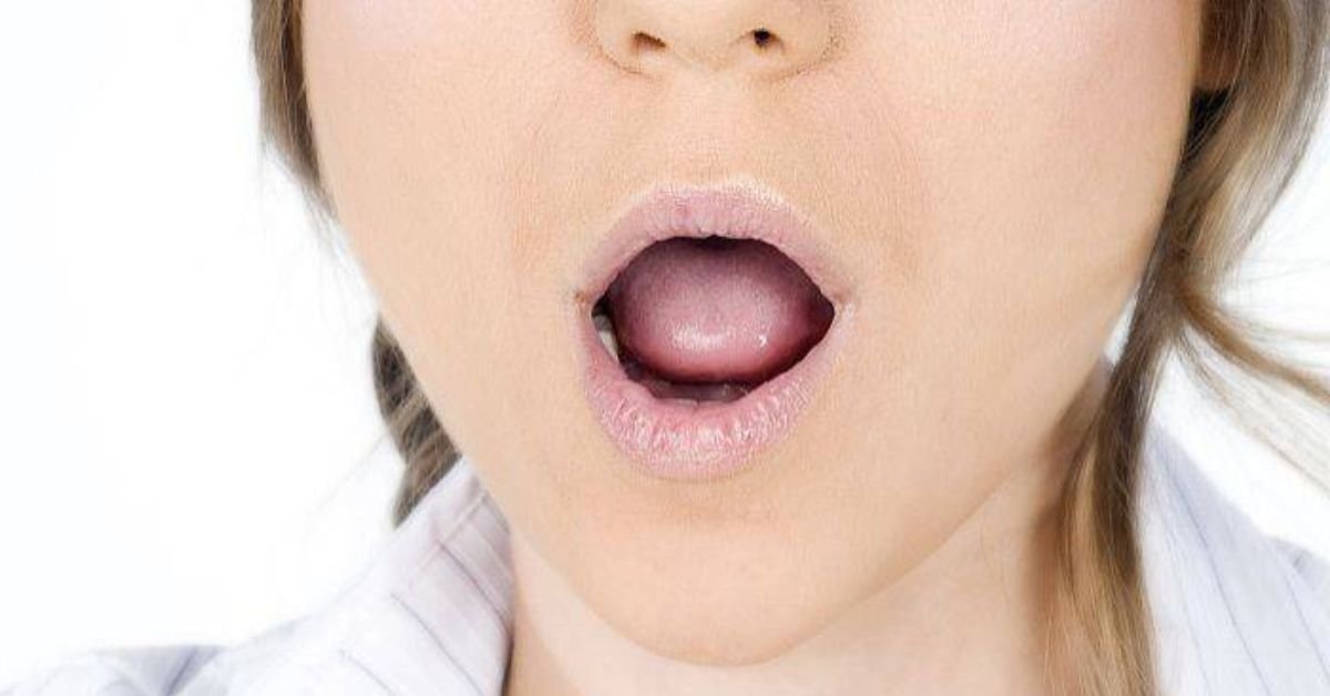 Xerostomia Boca Seca — Flori Odontologia
