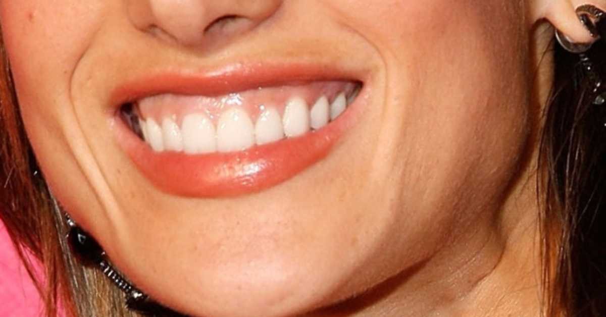 Sorriso Gengival Botox Cirurgia Valor