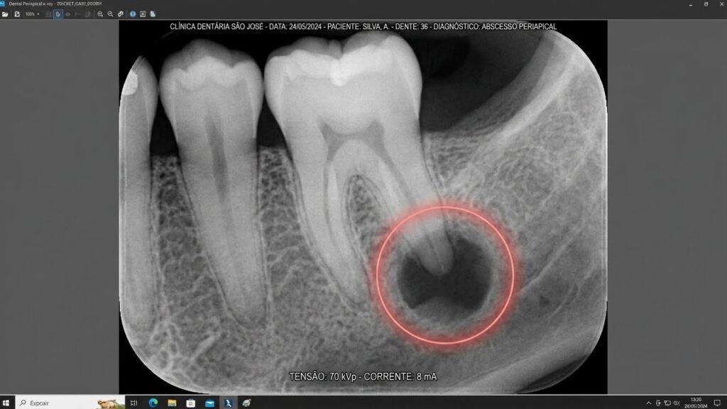 Raio-x periapical mostrando um dente com uma lesão escura na ponta da raiz, indicando um abscesso dentário e a necessidade de tratamento de canal.