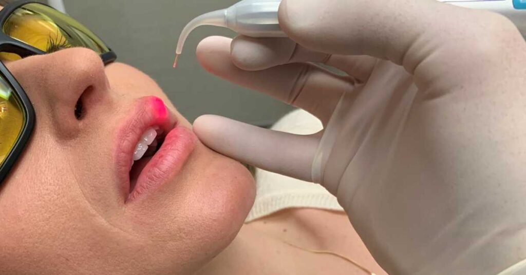 Tratamento para cura do Herpes Labial a Laser, inicio dos sintomas e causas