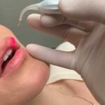 Tratamento para cura do Herpes Labial a Laser, inicio dos sintomas e causas