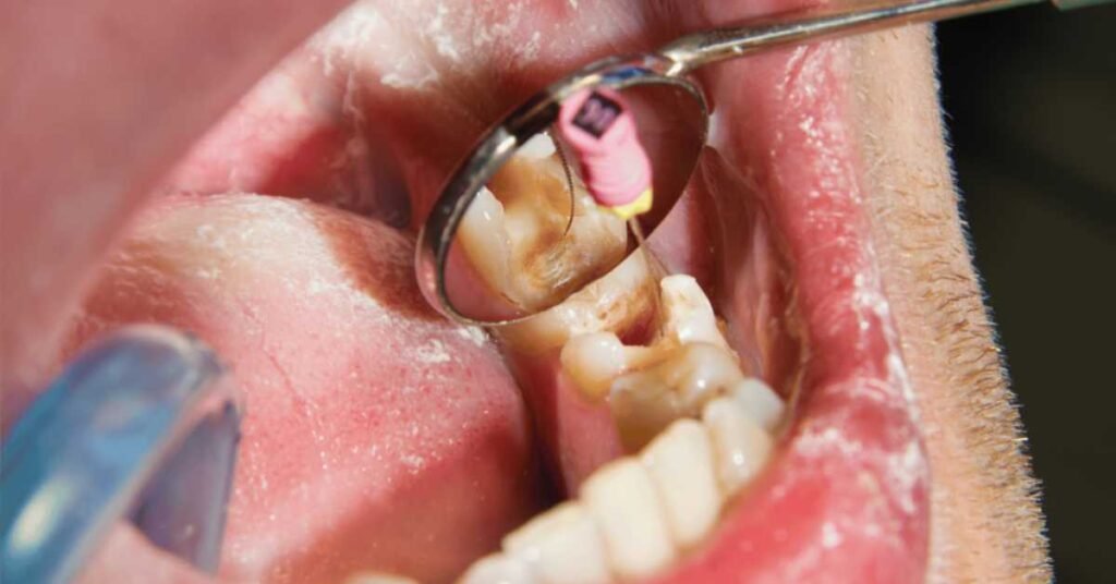 Retratamento de canal Endodontista Perdizes