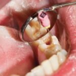 Retratamento de canal Endodontista Perdizes