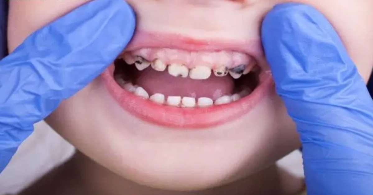 Tratamento Cáries Crianças odontopediatria Guará