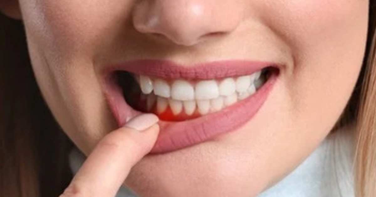 Gengiva Inflamada com pus como tratar o que fazer remédio