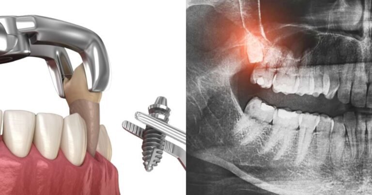O Implante Dentário Dói? Tudo sobre a colocação do pino sem dor