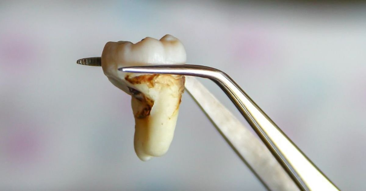 Extração do siso recuperação, complicações, cuidados e preço