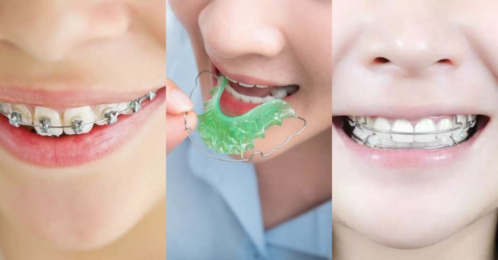 Invisalign First Aparelho Invisível Infantil para Crianças