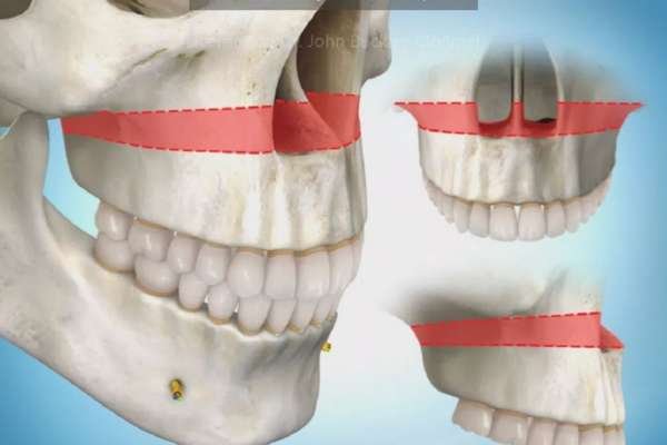 Médico Bucomaxilo para cirurgia de correção do sorriso gengival