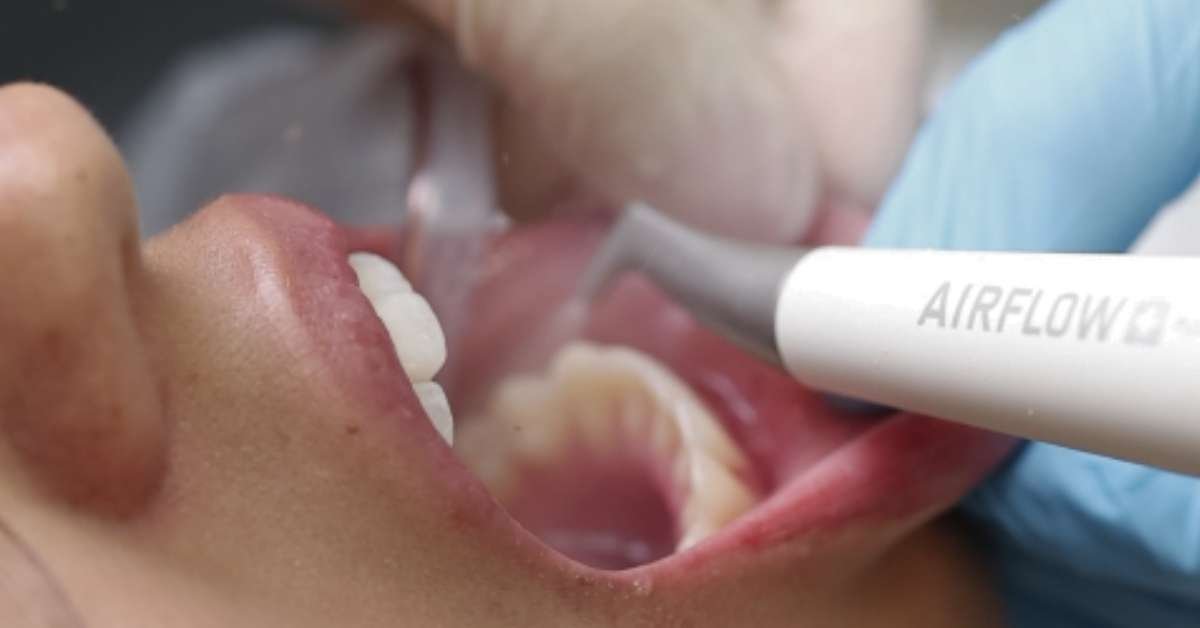 airflow profilaxia no dentista e limpeza na odontologia preço