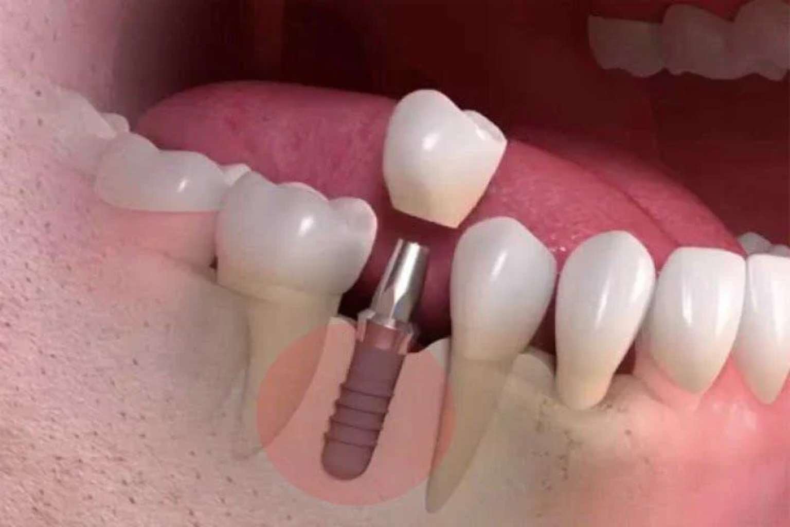 Implante Dentário sem Parafuso em Perdizes São Paulo