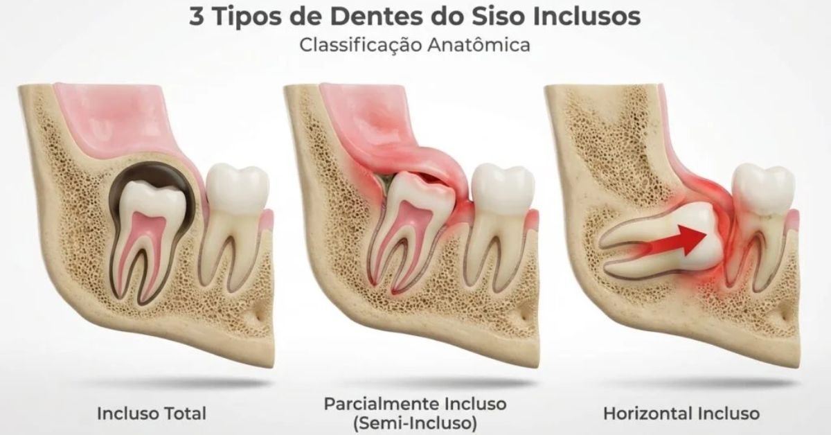 Ilustração 3D comparativa dos 3 tipos de siso: totalmente incluso, parcialmente incluso e impactado horizontal