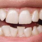 Invisalign funciona para mordida cruzada