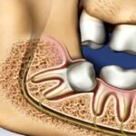 Extração de Siso Incluso e Impactado em Perdizes São Paulo