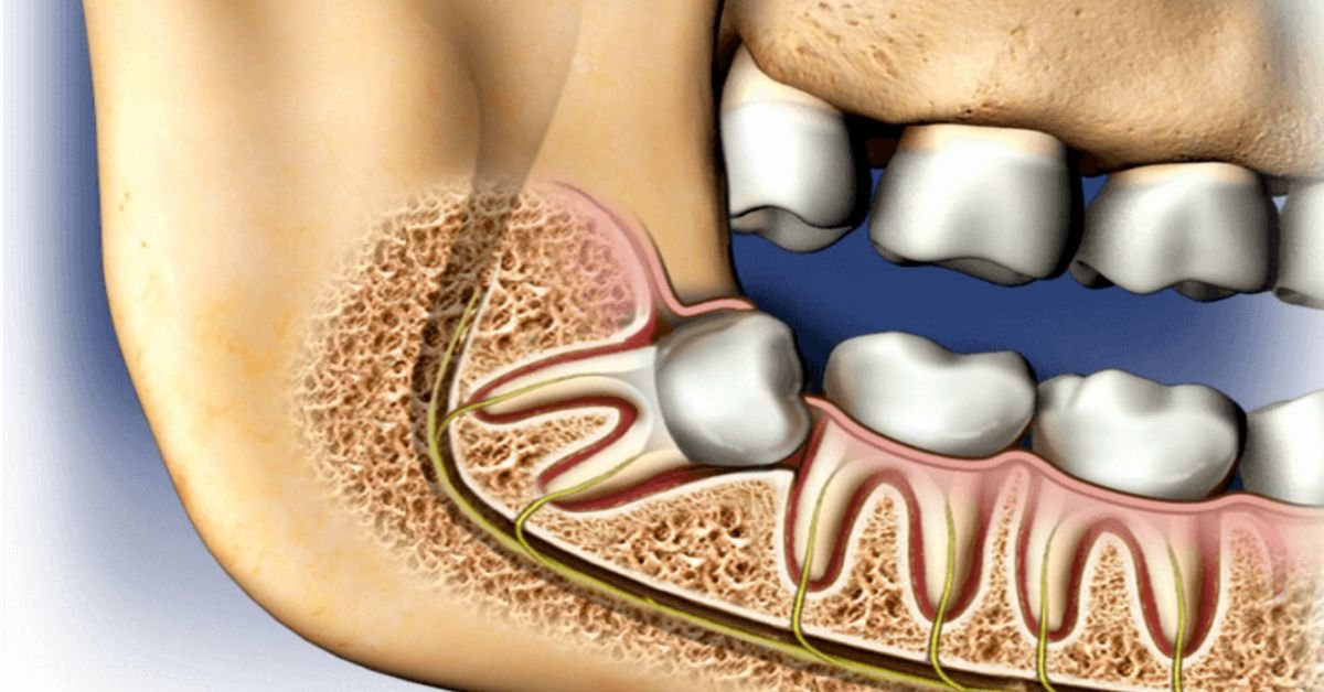 Extração de Siso Incluso e Impactado em Perdizes São Paulo