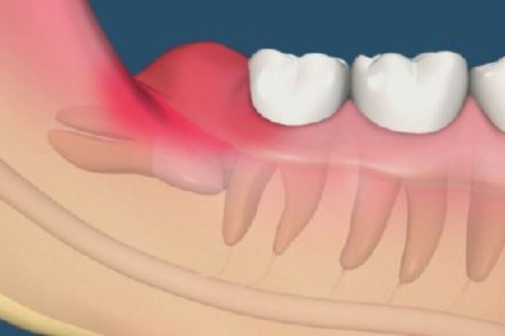 Extrair o dente do siso com inflamação recorrente