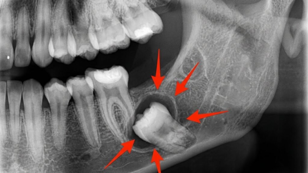 Cisto Dentário - Complicação Grave do Siso Incluso Raio-x de cisto dentário ao redor de siso incluso causando destruição óssea