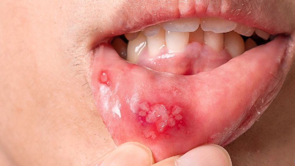Tratamento para aftas recorrentes que sempre voltam com laserterapia