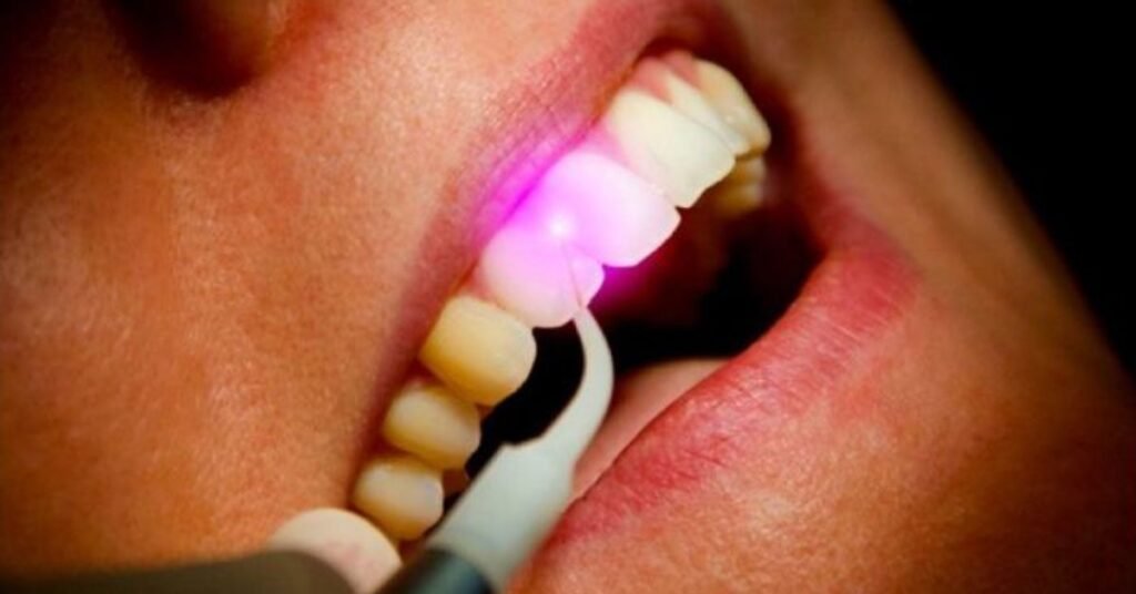 aumento de coroa clínica cirurgia para sorriso gengival a laser