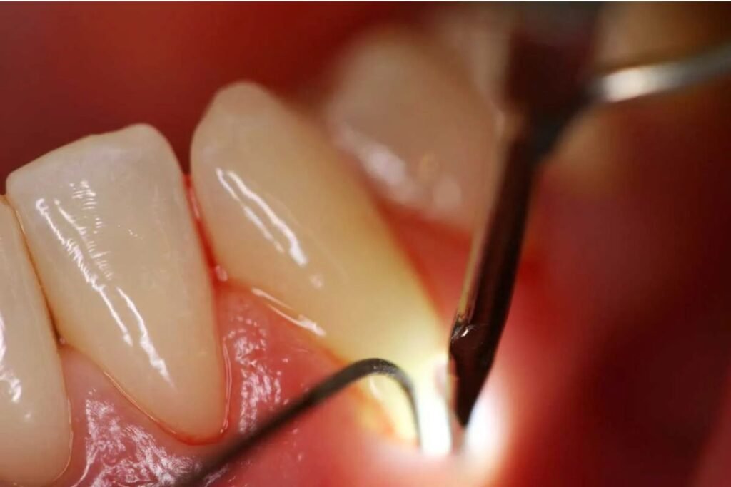 Retração Gengival Leve Tratamento com Periodontista Especialista em Perdizes SP