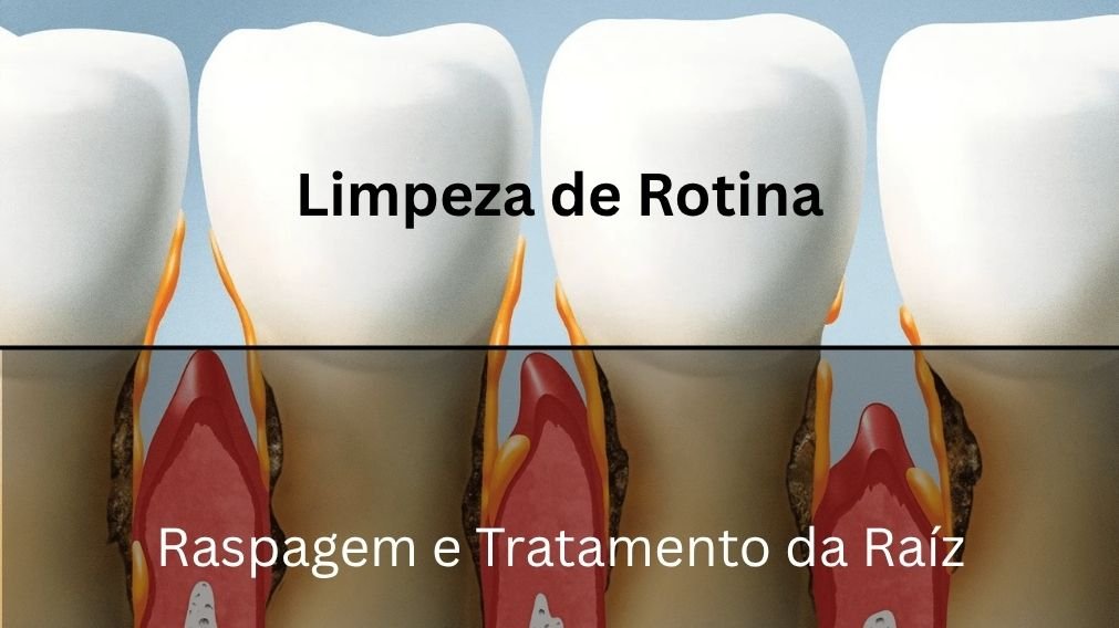 Raspagem periodontal e Limpeza Dentária normal