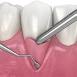 Cirurgia para Enxerto Gengival e tratamento da Gengiva