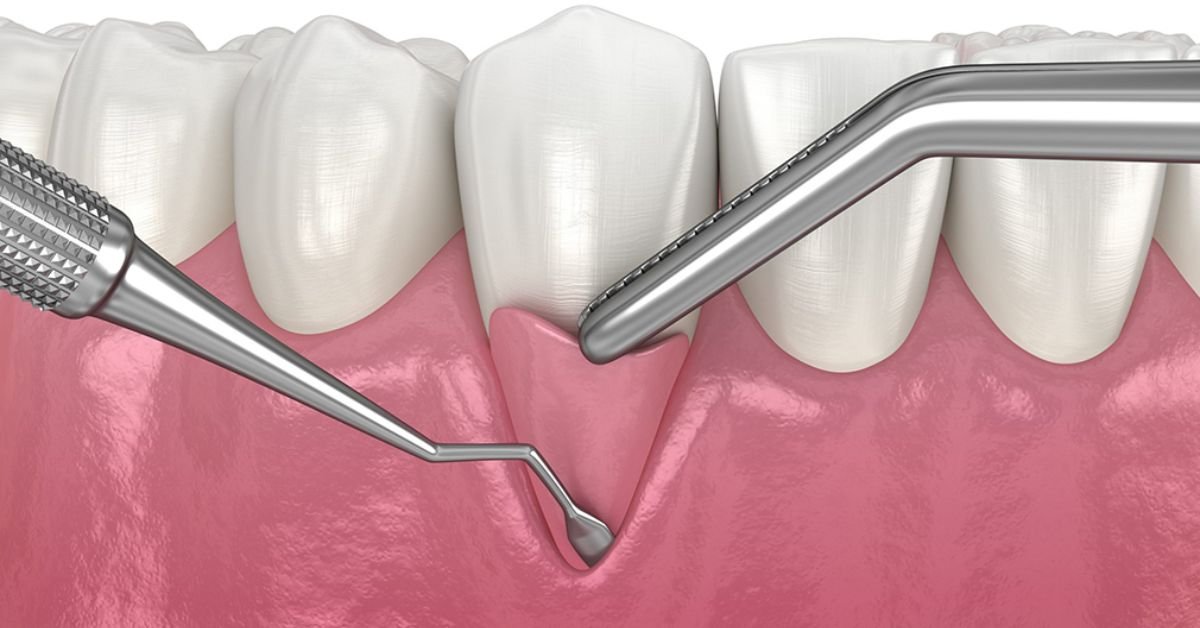 Cirurgia para Enxerto Gengival e tratamento da Gengiva