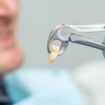 extrair o siso é perigoso?