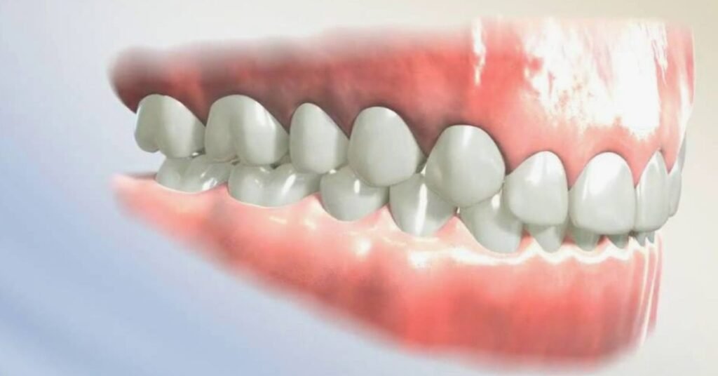 Invisalign para mordida profunda tratamento