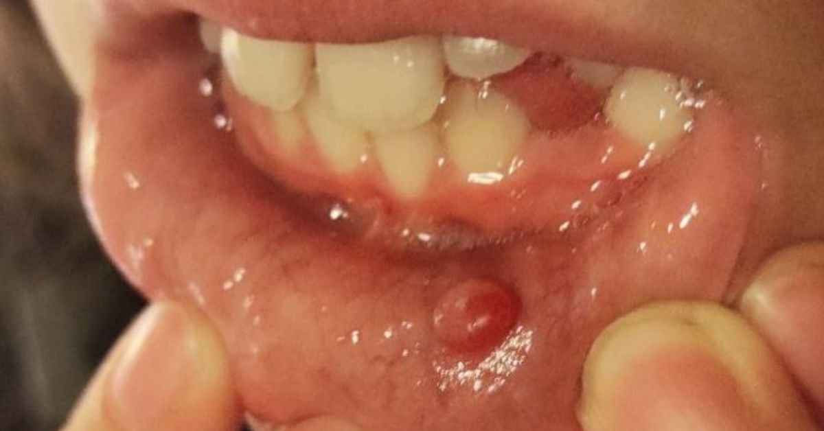 Mucocele no lábio inferior, bolha transparente característica de cisto mucoso que requer avaliação estomatológica