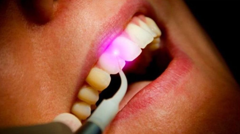 Aumento da Coroa Clínica com Laser Procedimento de aumento de coroa clínica com laser em Perdizes SP