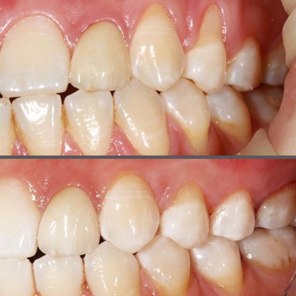 Retração Gengival Antes e depois do tratamento