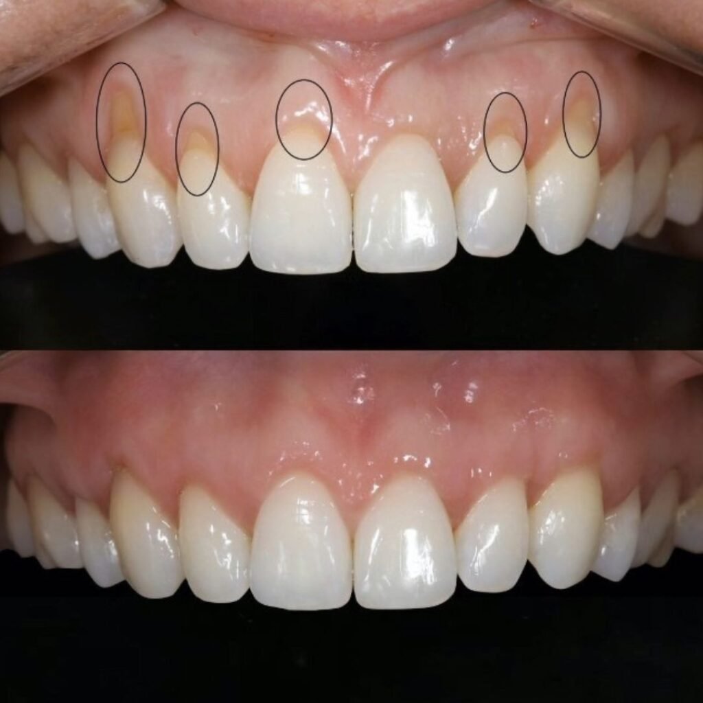 Retração Gengival Antes e depois do tratamento