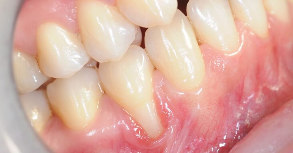 Retração Gengival Periodontista em Perdizes São Paulo SP