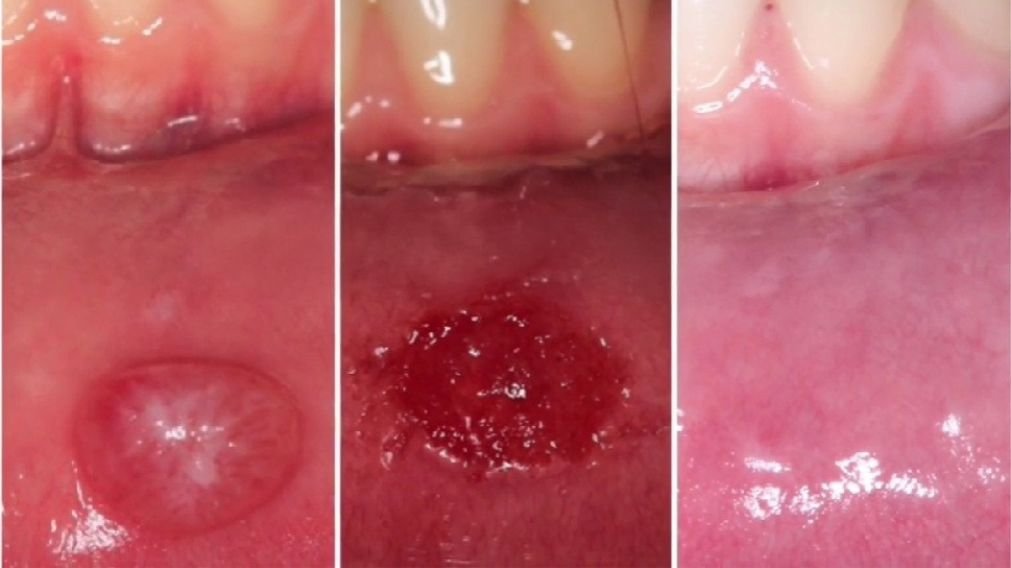 Resultado da remoção de mucocele a laser - Antes e depois Antes e depois da remoção de mucocele a laser mostrando cicatrização rápida em 3-5 dias sem cicatriz aparente