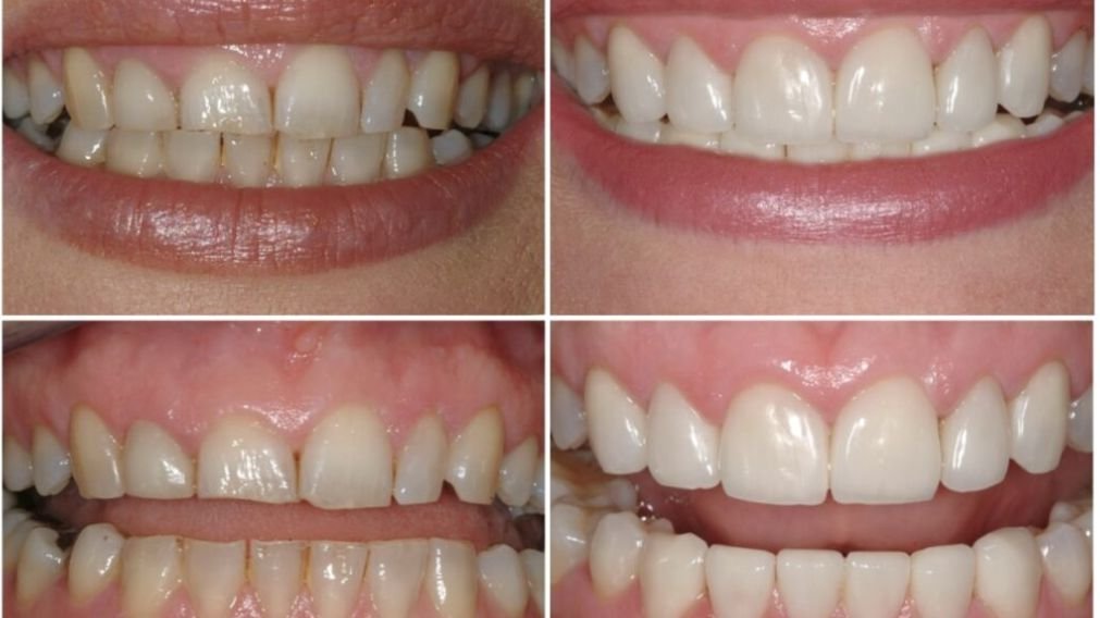 Aumento da Coroa Clínica - Antes e Depois Aumento da coroa clínica com laser antes e depois