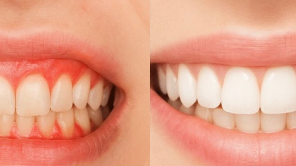 Comparativo entre uma gengiva saudável e outra com periodontite Comparação entre gengiva saudável e periodontite em paciente diabético