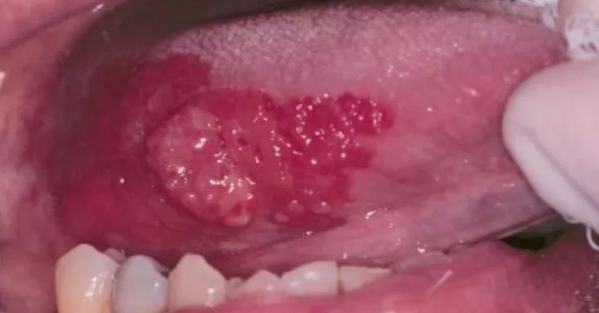 mancha vermelha na boca e eritroplasia tratamento em Perdizes São Paulo SP