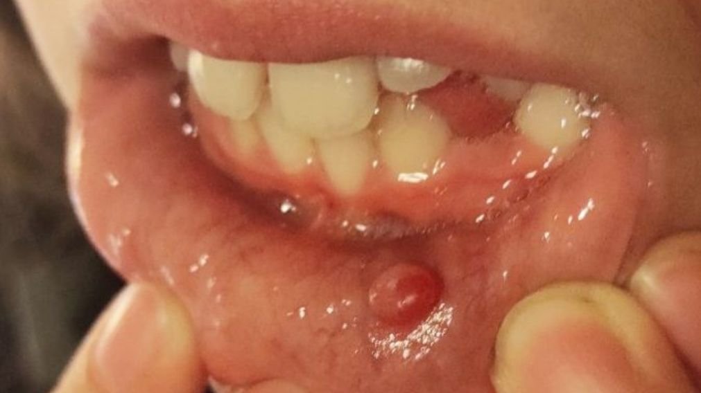 Mucocele - Bolha no lábio causada por bloqueio de glândula salivar Mucocele no lábio inferior, bolha transparente característica de cisto mucoso que requer avaliação estomatológica