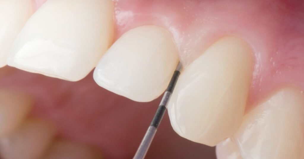 Tratamento de periodontite com especialistas em São Paulo