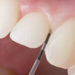 Tratamento de periodontite com especialistas em São Paulo