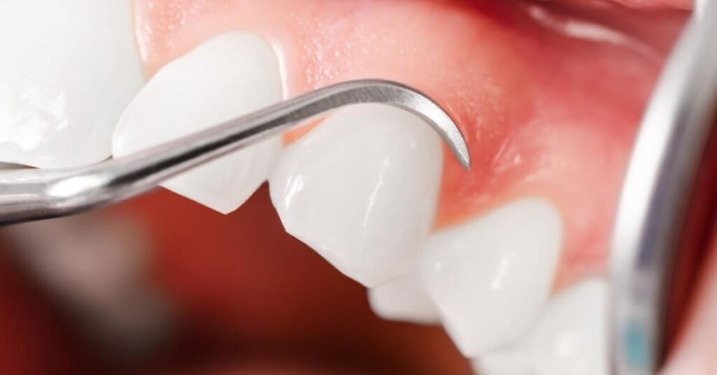 limpeza e raspagem periodontal subgengival e preço