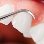 limpeza e raspagem periodontal subgengival e preço